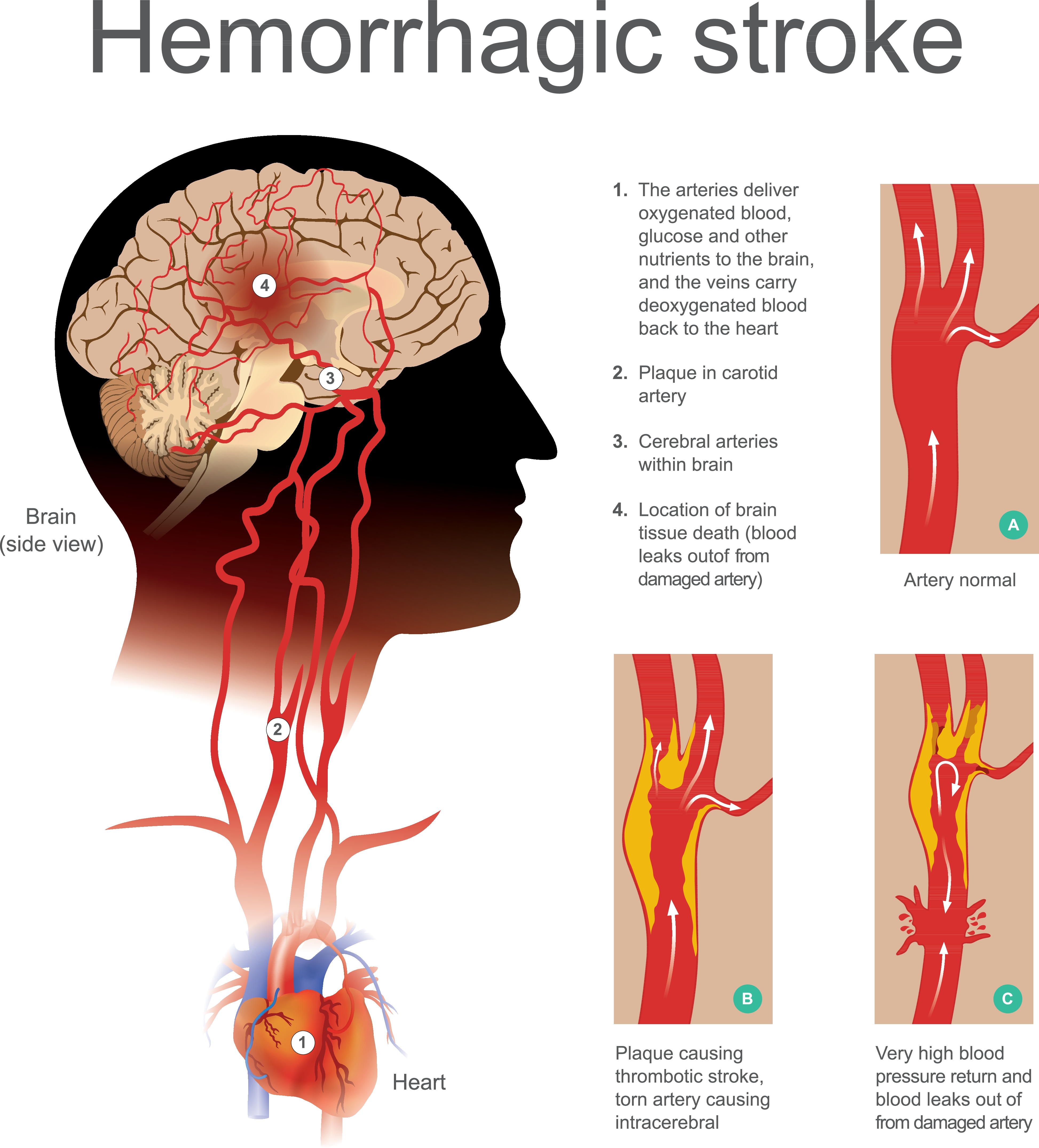 Stroke encouragement